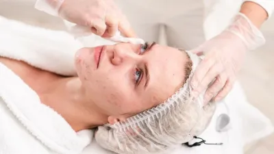 Acne Treatment Facial Near Me for Clearer, Healthier Skin