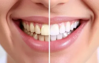 An entire Guide to a professional teeth whitening in Coventry.