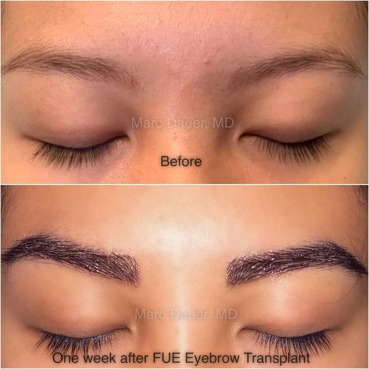 Eyebrow Transplant Dubai – Restore Fuller